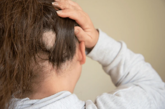 Losing Hair, Not Identity: Coping with Lupus-Related Hair Loss and How Wigs Can Help