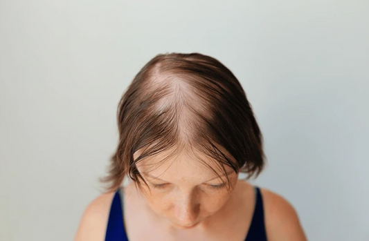 Thinning Crowns & Strong Spirits: Understanding Androgenetic Alopecia and How Wigs Can Help