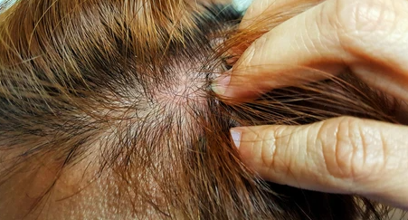 When the Scalp Struggles: How Infections Can Cause Hair Loss And How Wigs Can Help