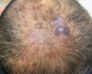 Cicatricial Alopecia: When Hair Loss Leaves a Scar