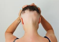 Androgenetic Alopecia: The Most Common Cause of Hair Loss (and What You Can Do About It)