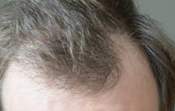 Understanding Telogen Effluvium and Hair Loss: You’re Not Alone (And Yes, Wigs Are Totally an Option