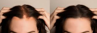 Losing Hair, Not Confidence: Understanding Hair Loss & How Wigs Can Help You Thrive