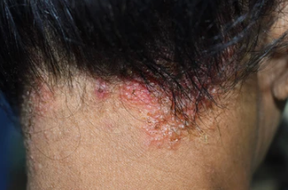 From Itchy Scalp to Confident Style: Managing Infections and Embracing Wigs