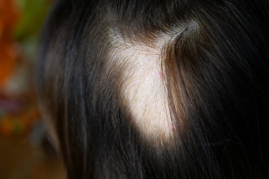 Understanding Traction Alopecia: Who’s at Risk and How Wigs Can Help