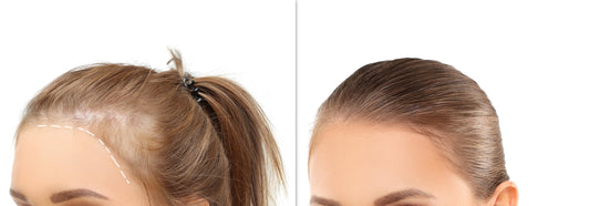 Healing from the Scalp Up: Managing Hair Loss and Finding Confidence with Wigs