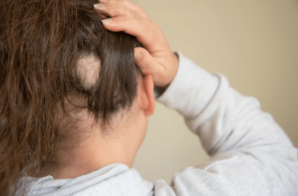 Losing Hair, Not Identity: Coping with Lupus-Related Hair Loss and How Wigs Can Help