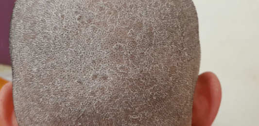Tinea Capitis Explained: Hair Loss, Healing, and the Role of Wigs