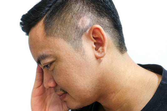 Cicatricial Alopecia Explained: Why Wigs Are More Than Just a Cover-Up
