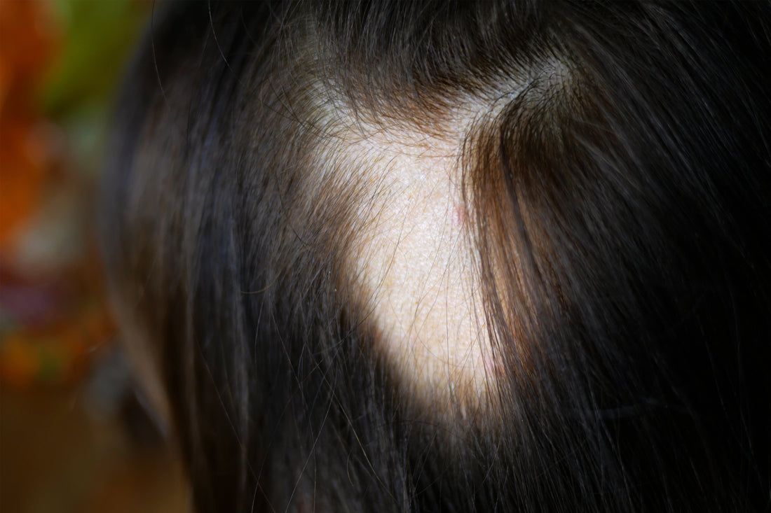 Understanding Traction Alopecia: Who’s at Risk and How Wigs Can Help