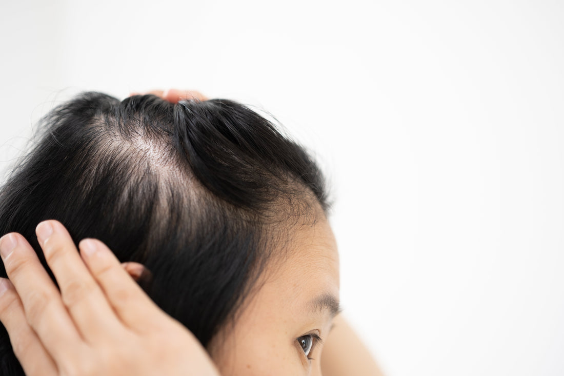 Understanding Cicatricial Alopecia: Hair Loss and How Wigs Can Help